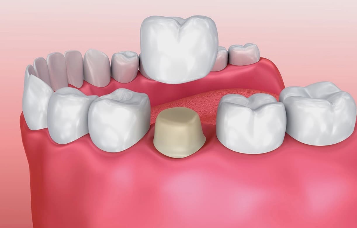 Same Day Crowns