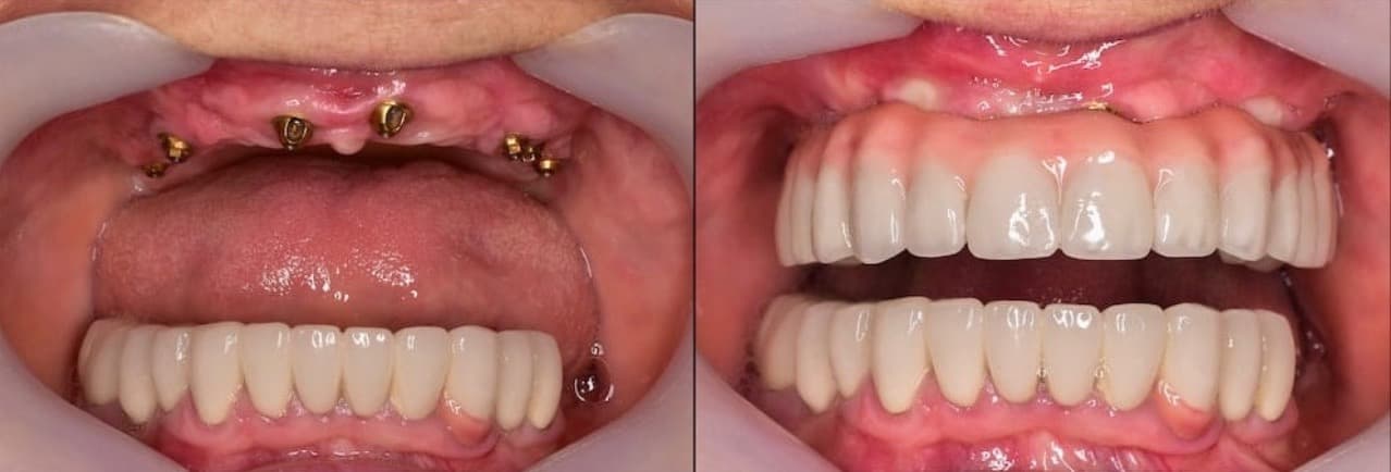 Dentures