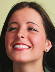 Teeth Whitening
