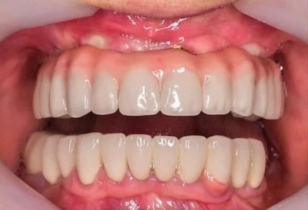 Tired of Dentures that don't stay in?