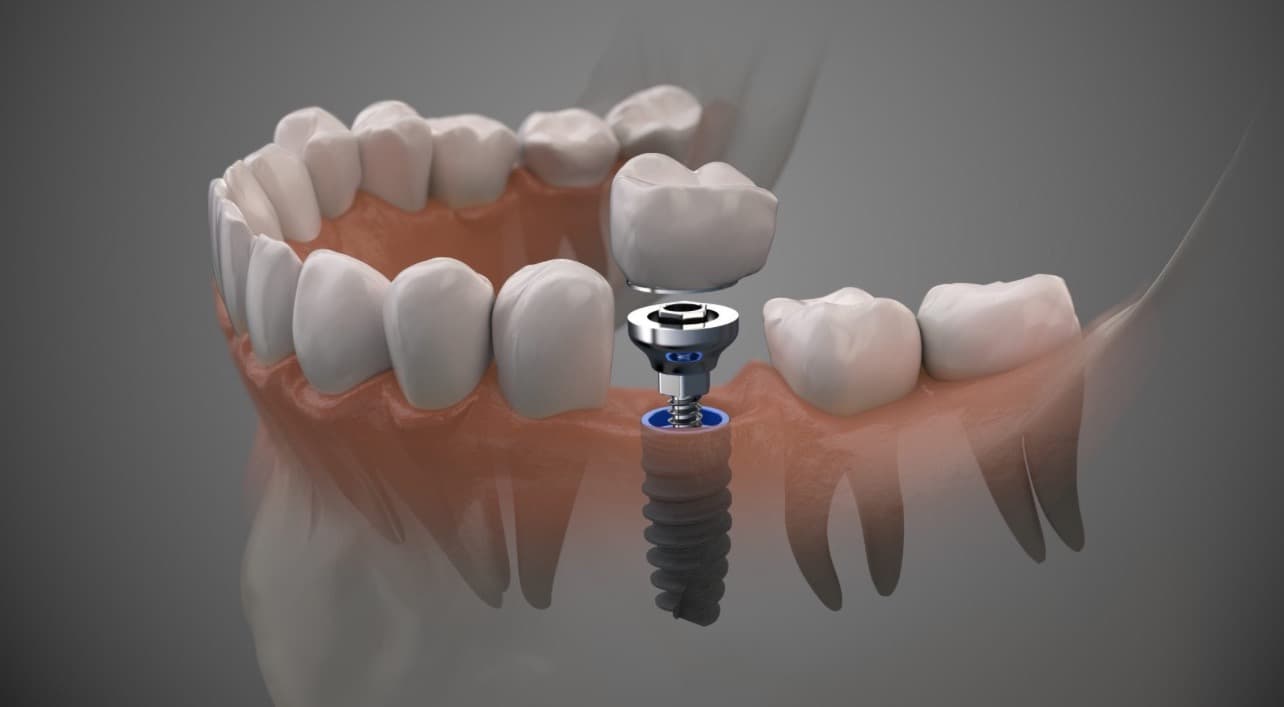 Implant Restorations
