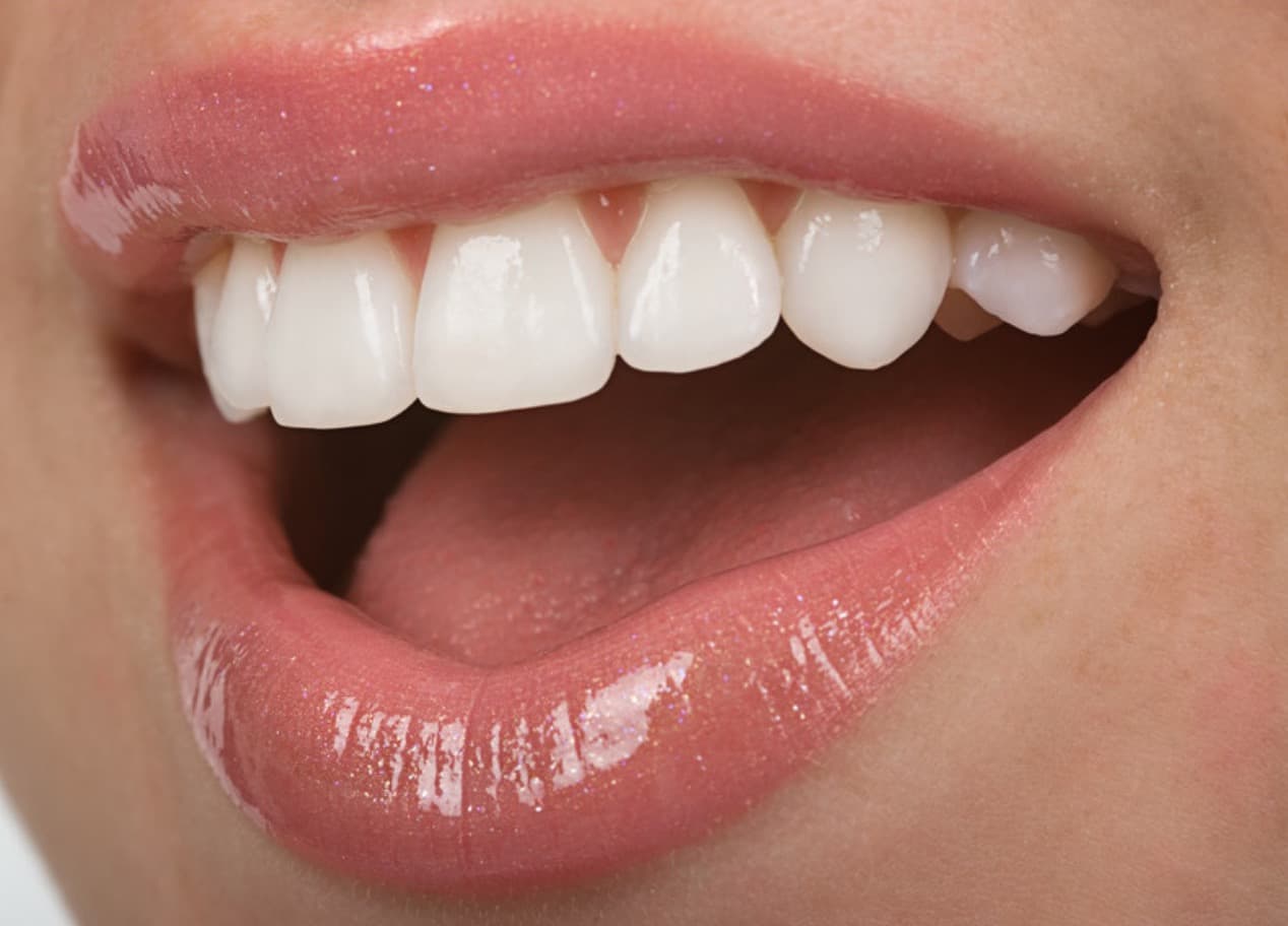 Cosmetic Porcelain Veneers